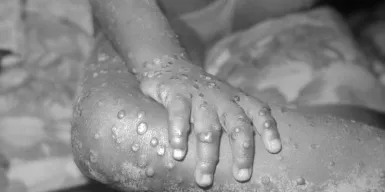 Зафиксирована первая смерть человека от оспы обезьян